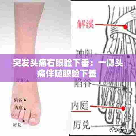 突发头痛右眼睑下垂：一侧头痛伴随眼睑下垂 