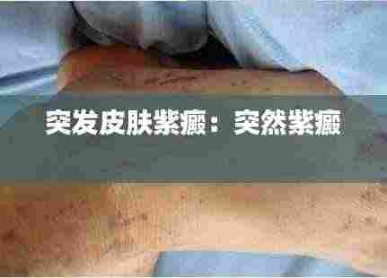 突发皮肤紫癜:突然紫癜